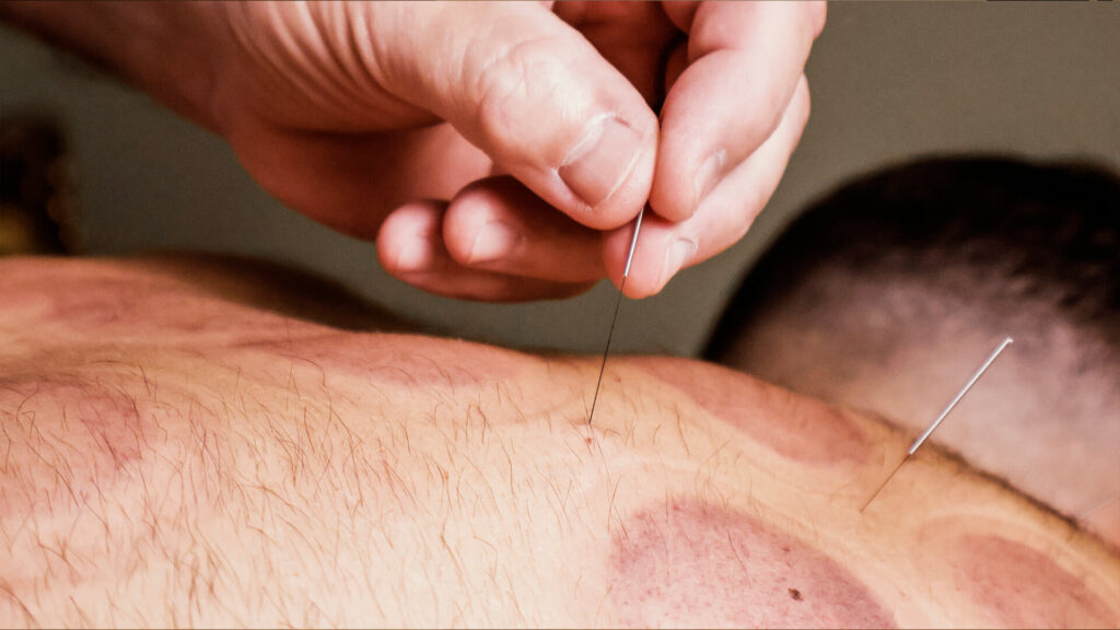 A man receiving an acupuncture treatment at Sacred Moments Massage & Healing Center.