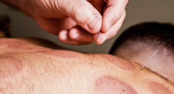 A man receiving an acupuncture treatment at Sacred Moments Massage & Healing Center.