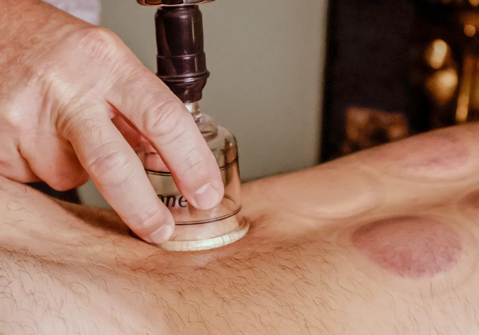 cupping-at-sacred-moments A cupping session at Sacred Moments Massage & Healing Center.